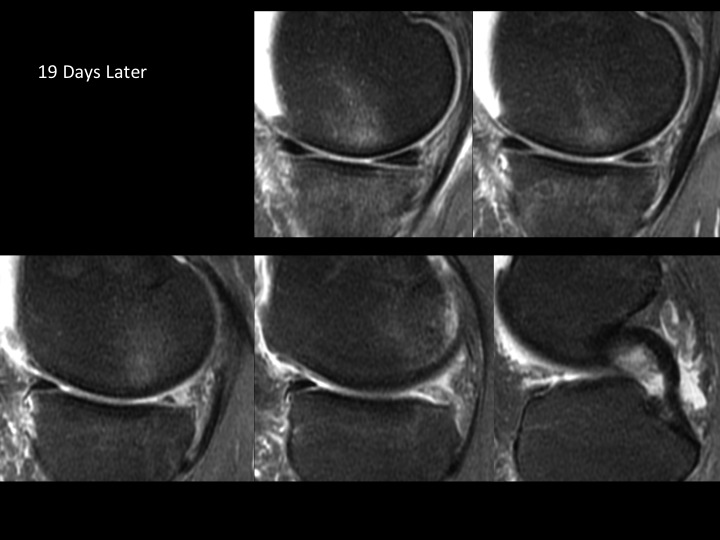 Figure 3 for case posterior root of medial meniscus ( RID2777 )